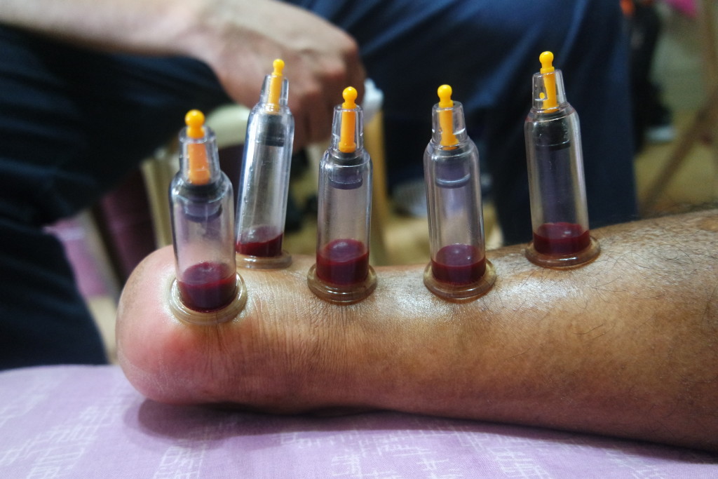 ventosa-cupping-therapy-blood-sucking-massage